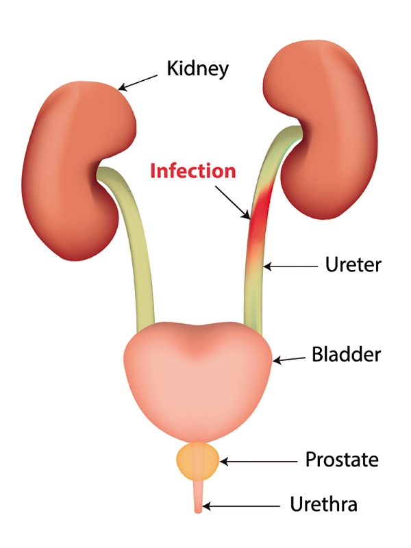 urinary-tract-infection-complicated-signs-and-symptoms-mims-vietnam